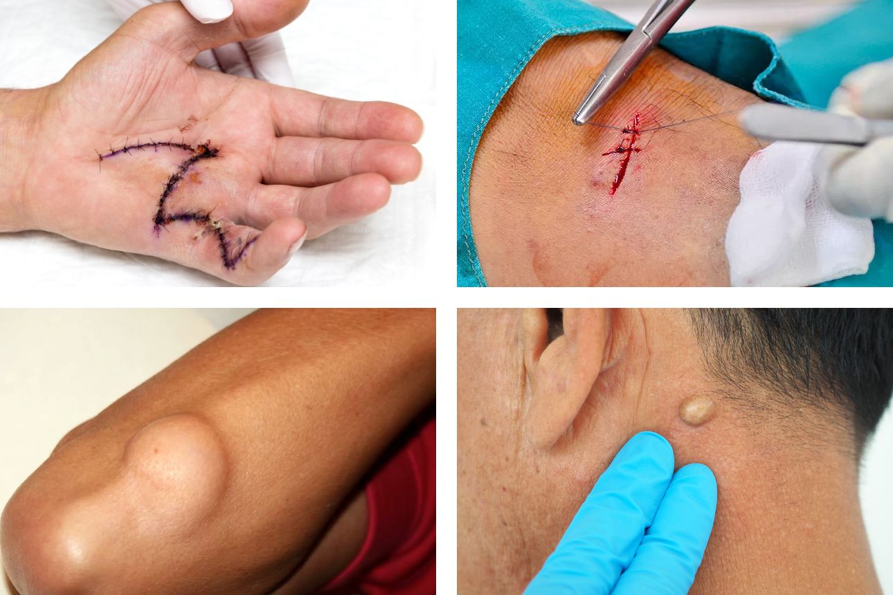 Chirurgie generală / Intervenții de mică chirurgie