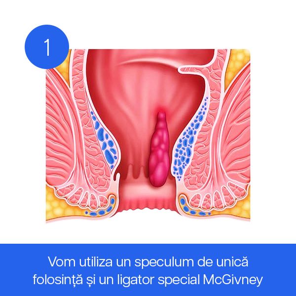 Vom utiliza un speculum de unică folosință și un ligator special McGivney