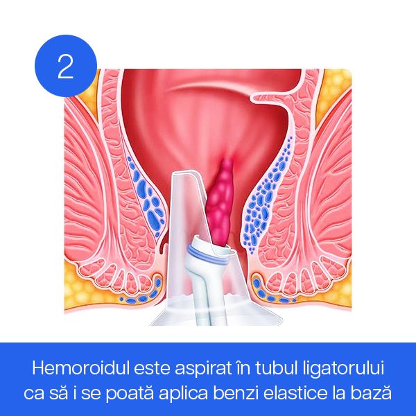 Hemoroidul este aspirat în tubul ligatorului ca să i se poată aplica benzi elastice la bază